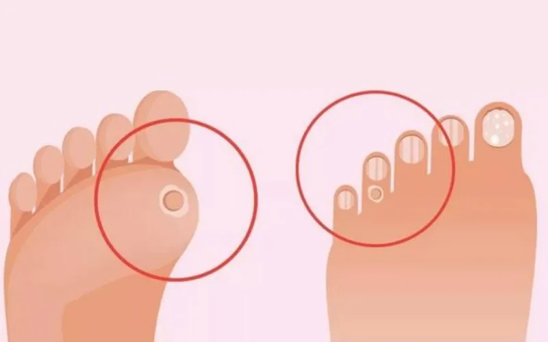 علاج مسمار القدم نهائيًا: الدليل الشامل للوقاية والعلاج الطبيعي والطبي
